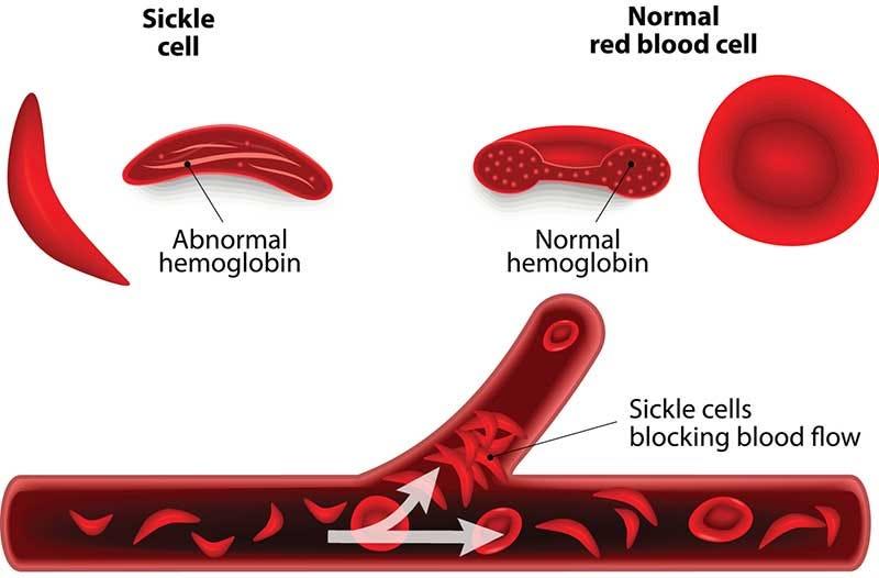 Sickle Cell Disease Symptoms, Types and Complications