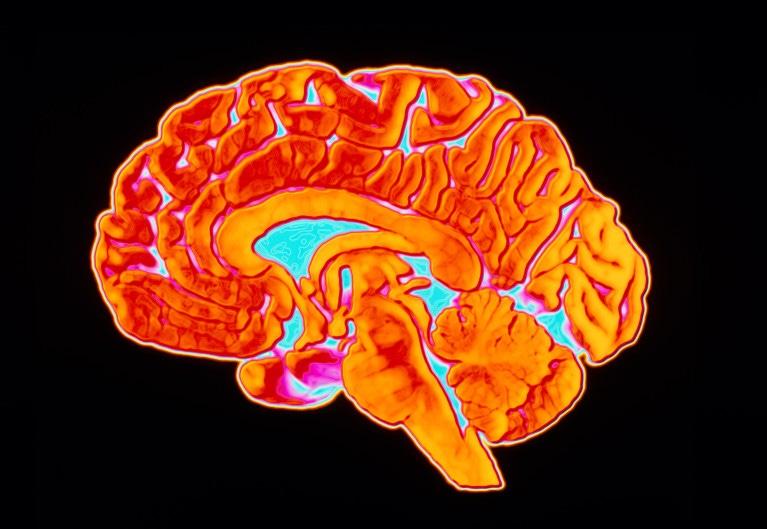 A side-view of a coloured CT scan through a human brain, with the front of the brain on the left hand side. It is coloured in various shades of orange, yellow, blue and pink and is on a black background